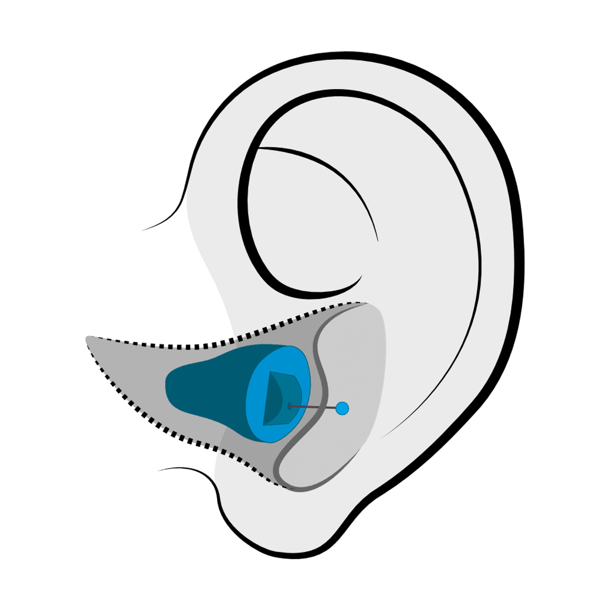 Invisible-in-Canal (IIC) hearing aid style fitted at Hughes Holistic Audiology in Zionsville, IN
